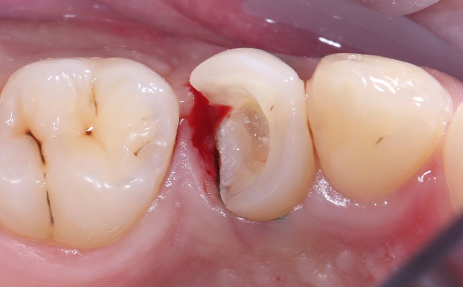 Fig. 2 After removal of the old composite filling, an inflammatory bleeding of the gingiva appeared on the proximal box.