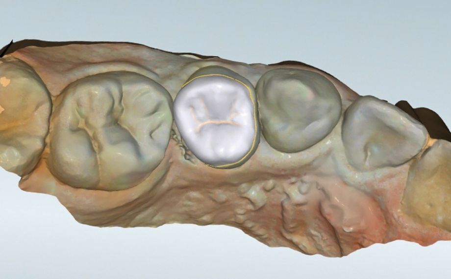 Fig. 6 The virtual design in occlusal view before nesting in the virtual block.