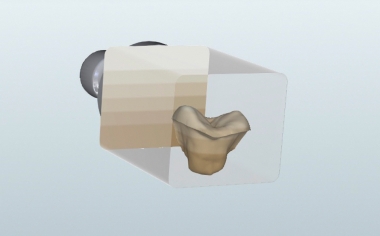 Fig. 7 Thanks to six finely nuanced layers, the shade and translucency gradient of the restoration could be controlled with the positioning.