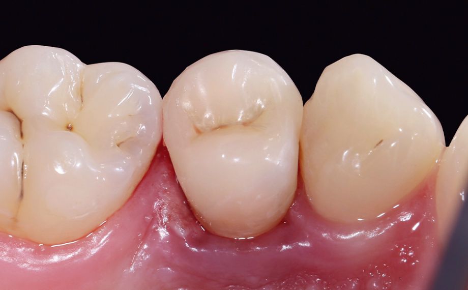 Fig. 13 Immediately after the final seating, the gingiva was still irritated and inflamed.