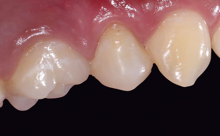 Fig. 14 During the follow-up after three months, healthy gingival conditions appeared.