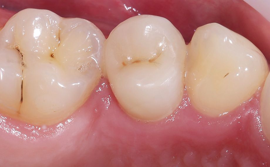 RESULT Thanks to the very good light-optical properties, the reconstruction made of VITA ENAMIC multiColor integrated perfectly into the natural tooth substance.