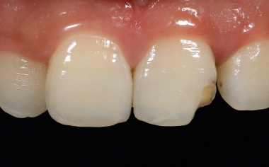 Fig. 2 Secondary caries had formed under a direct composite abutment, which led to a filling fracture.