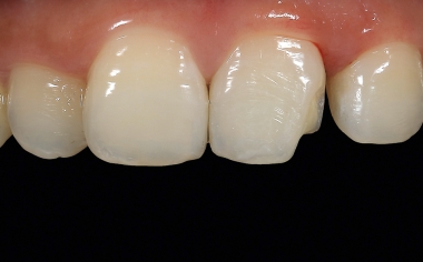 Fig. 4 The caries was removed under local anesthesia and the edge areas in the enamel were slightly tapered.