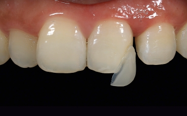 Fig. 5 The CAD/CAM-supported finished restoration made of VITA ENAMIC with wafer-thin edges.