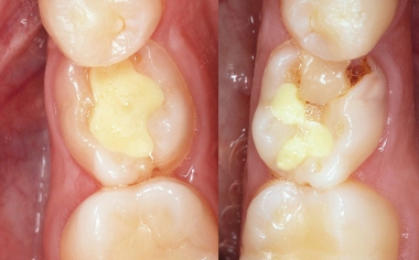INITIAL SITUATION The initial situation with persistent primary teeth that are not worth preserving in regions 34 and 35.