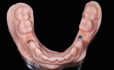 Fig. 5 The model was created using additive manufacturing with integrated implant analogs in regions 34 and 35.