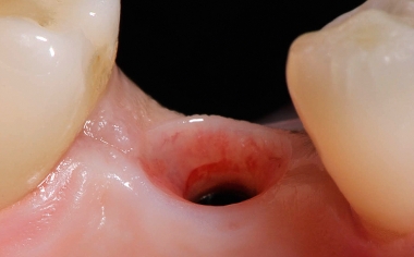 Fig. 6 The soft tissue healed until the final restoration with gingiva formers.