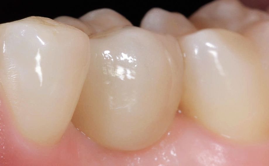 Fig. 10 The situation in region 34 immediately after fulladhesive seating of the feldspar ceramic crown made of VITABLOCS TriLuxe forte.