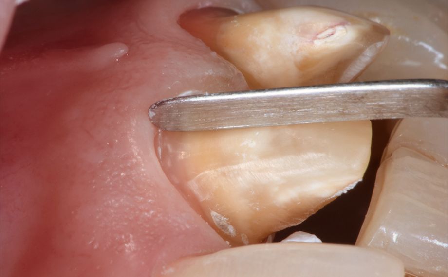 Fig. 2 During the preparation, a precise preparation limit and all-ceramic design was achieved.