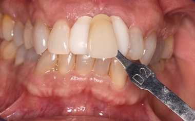 Fig. 5 Digital photographs with the selected shade guide were taken for the laboratory.