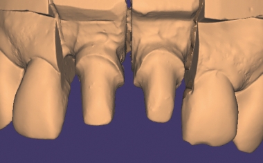 Fig. 6 The master model produced was digitalized using the lab scanner.