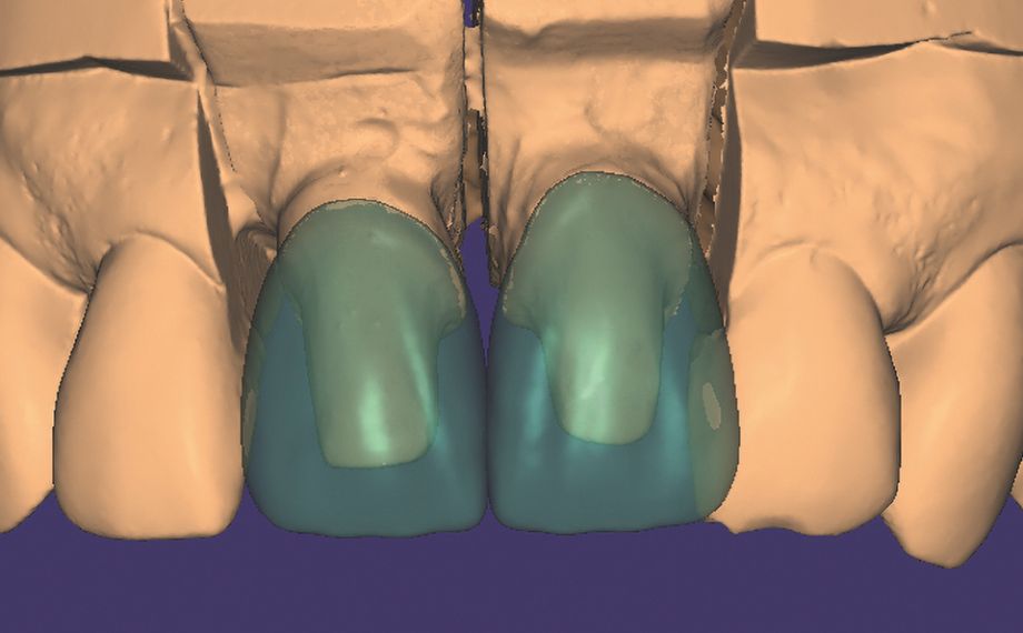 Fig. 7 In the exocad CAD software, crowns were constructed on stumps 11 and 21.