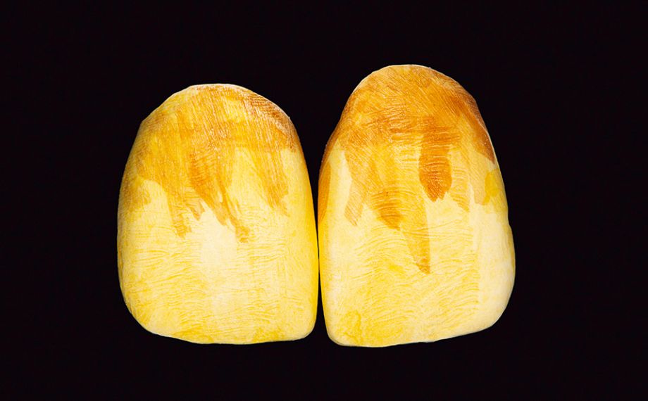 Fig. 10 The basic color and the chroma in the cervical third were intensified with D3 coloring.