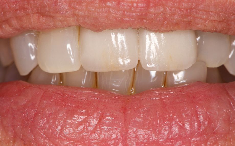 RESULT The two crowns fit harmoniously into the natural dental arch and look absolutely natural.