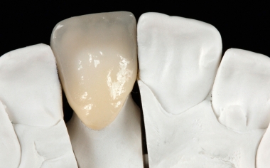 Fig. 4 Palatal view of the finished crown on the model.