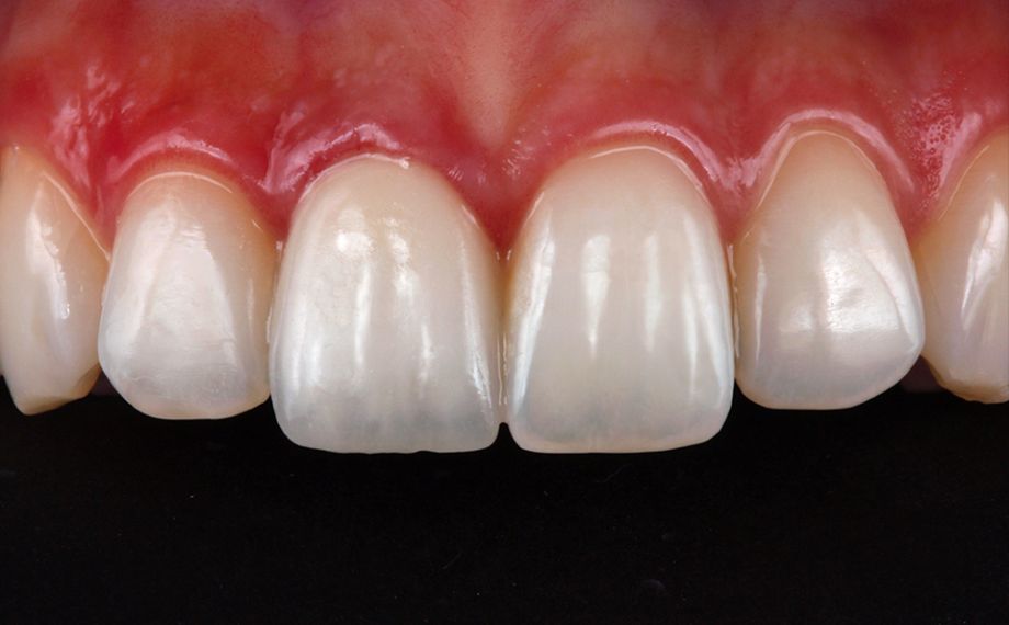RESULT The crown integrated harmoniously into the dental arch and showed a highly esthetic play of color and light.