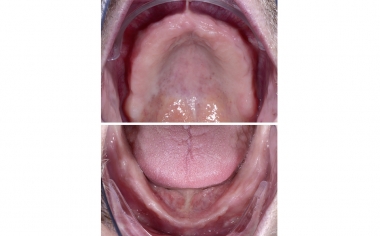 INITIAL SITUATION Except for the pointedly tapering hyperplastic mucosal tissue in the incisal area, the lower jaw also offered stable conditions.