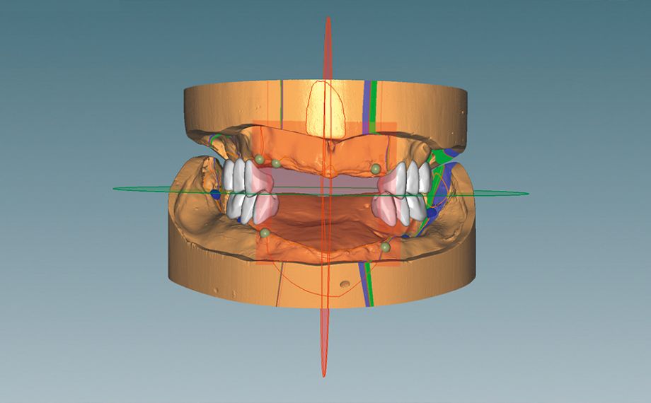 Fig. 4 At the touch of a button, the posterior teeth could then be set up with VITAPAN LINGOFORM.