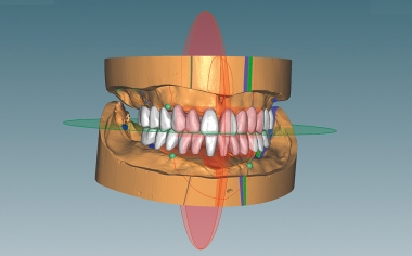 Fig. 5 With a second push of a button, the VITAPAN EXCELL was positioned in the anterior region.