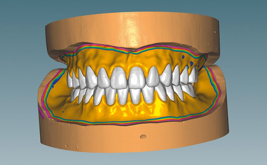 Fig. 6 Afterwards, the functional edges could be defined and the denture bases could be designed.