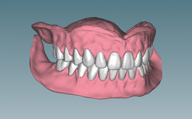 Fig. 7 The finished fabricated total prosthetic restorations in final bite position.