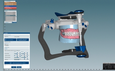 Fig. 8 Finally, the dynamic occlusion was checked in the virtual articulator.
