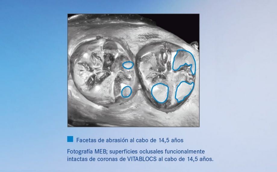 Gráfico 2 Las restauraciones de VITABLOCS presentaron en estudios un comportamiento de abrasión similar al natural.Fuente: análisis externo 2016, Universidad de Zúrich/Clínica am Zürichberg (Suiza), modelo en resina epoxi de la impresión al cabo de 14,5 años vaporizado con oro, fotografía en blanco y negro del modelo (Dr. Andreas Bindl, profesor agregado).
