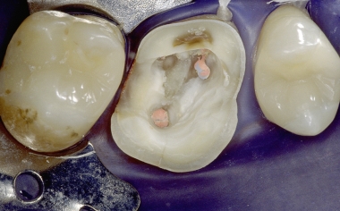 Fig. 1a Preparación de la endocorona con retención reducida y unión adhesiva principal en la dentina, menos propicia.