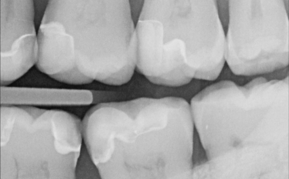 Fig. 2a Inlay intacto (om) en el diente 17 al cabo de 14 años.