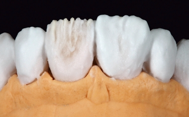 Fig. 6 Para la estratificación final de las seis carillas se utilizó ENAMEL light.