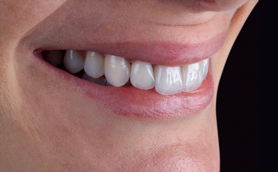 Fig. 9 Se configuró la arcada dentaria conforme a las reglas de la estética.