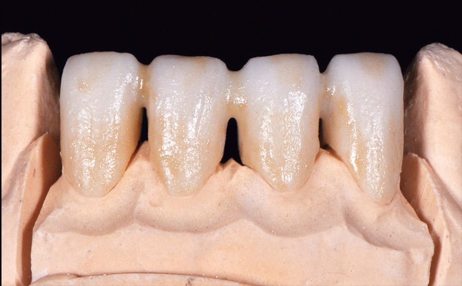 Fig. 2 Cocción wash con FLUO INTENSE sand e incisal con sesame.