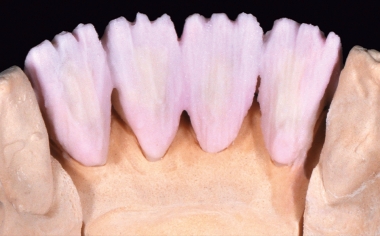 Fig. 4 En la zona palatina se aplicó una mezcla 50:50 de DENTINE A 3.5 y DENTINE MODIFIER copper.