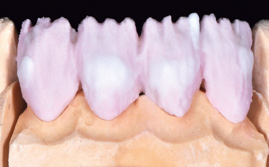 Fig. 6 La aplicación de cerámica central de A3 mezclando OPAL TRANSLUCENT opal-neutral.