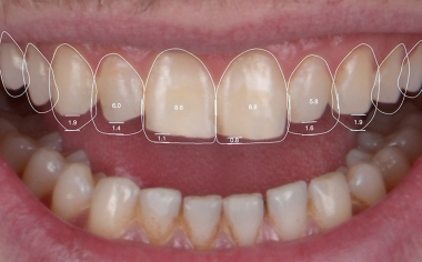 Fig. 3 En una aplicación se modificaron virtualmente las proporciones dentales.