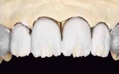 Fig. 12 La zona de dentina se estratificó con LUMINARY 1 (blanco) y DENTINE 1M1.