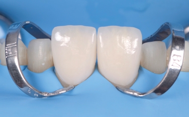 Fig. 14 La prueba final en boca de las carillas en los dientes 11 y 21.