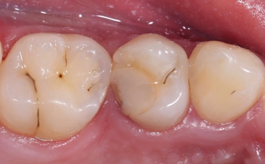 Fig. 1 La obturación de composite insuficiente en el diente 14 (od) había provocado inflamaciones en el espacio interdental.