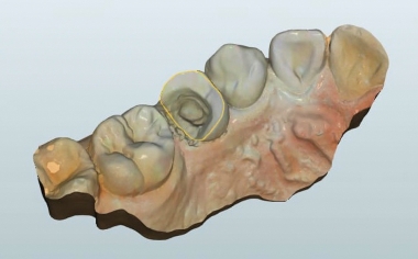 Fig. 4 Sobre la base del escaneo intraoral se confeccionó un modelo maestro para el diseño.