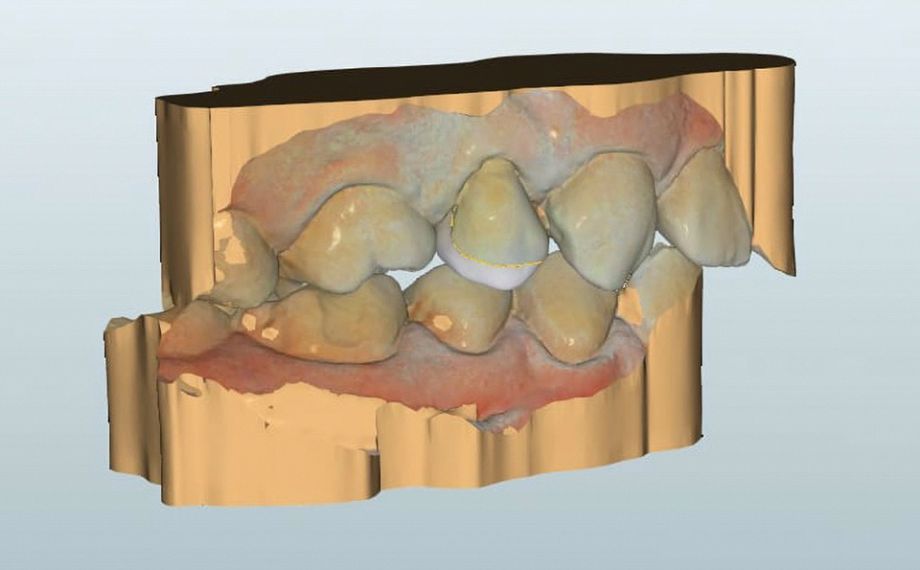 Fig. 5 Vista vestibular del diseño virtual terminado de la restauración con endocoronas.