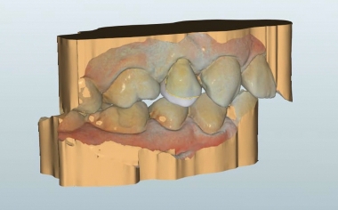 Fig. 5 Vista vestibular del diseño virtual terminado de la restauración con endocoronas.