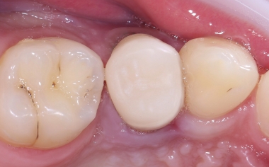 Fig. 9 La restauración confeccionada mediante CAD/ CAM, durante la prueba clínica en boca tras el acabado.