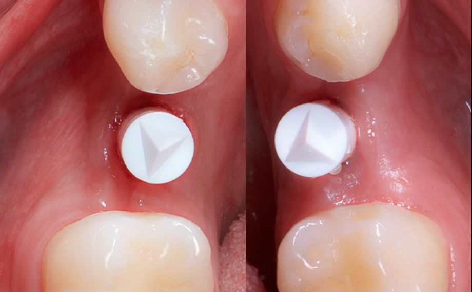 Fig. 2 Tras la cicatrización de los implantes, se procedió a su exposición y a la colocación de cuerpos de escaneo para la toma de impresión virtual.