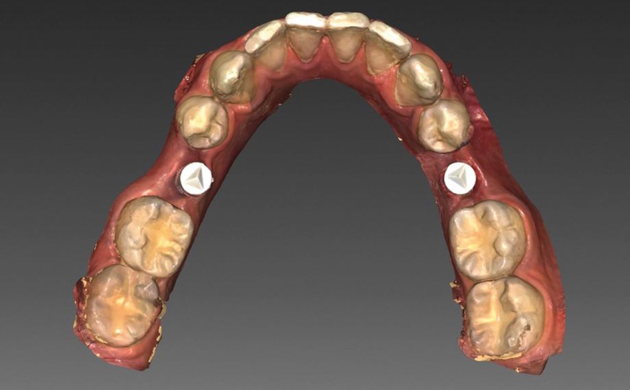 Fig. 3 La situación intraoral escaneada en el maxilar inferior en el software InLab-CAD.