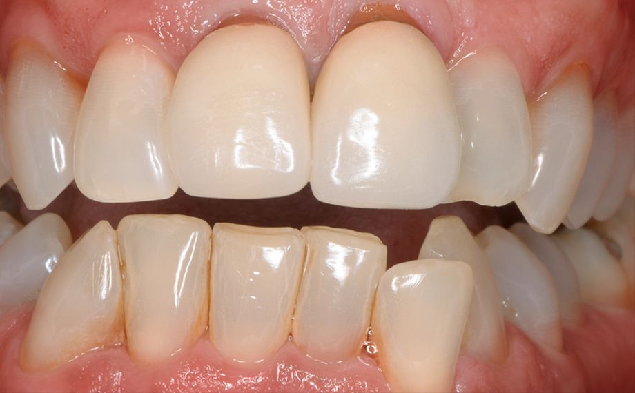 SITUACIÓN DE PARTIDA: la situación de partida con coronas metalocerámicas insuficientes y de aspecto apagado en los dientes 11 y 21.