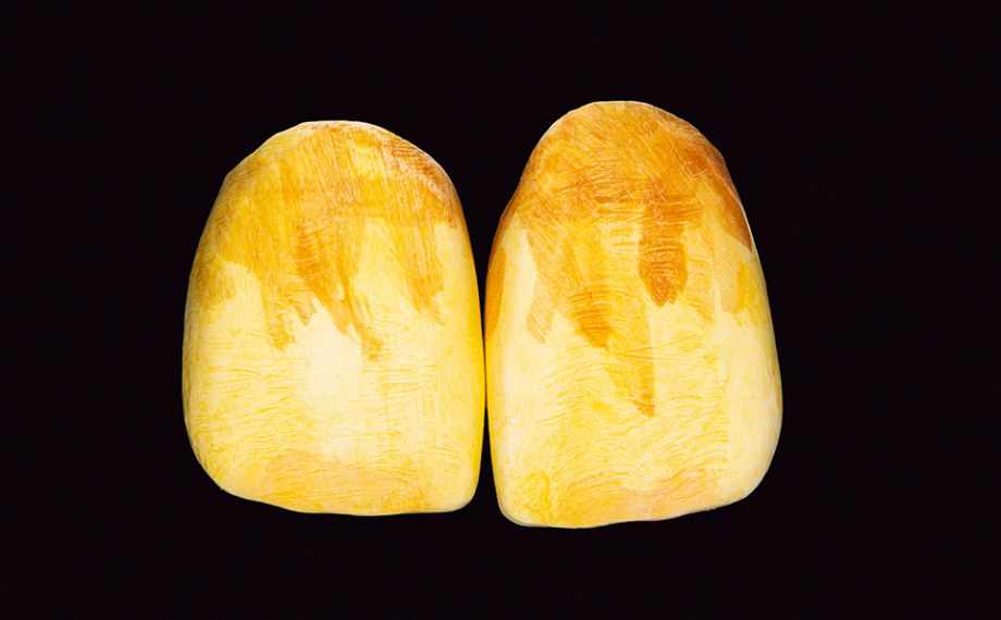 Fig. 11 Se realizó por incisal una infiltración con VITA YZ EFFECT LIQUIDS Orange.