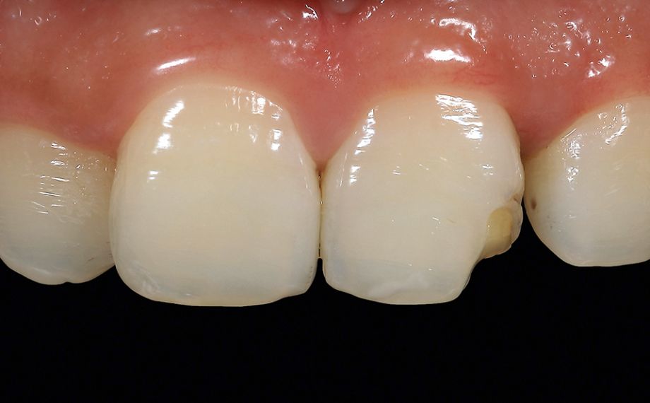 Fig. 2 Bajo una reconstrucción directa con composite se había formado una caries secundaria que condujo a la fractura de la obturación.