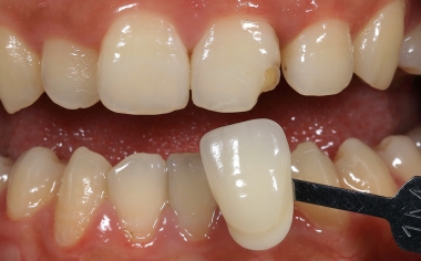 Fig. 3 Mediante la guía VITA Linearguide 3D-MASTER se determinó sistemáticamente el color dental en dos pasos.