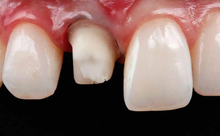 Fig. 1 Se preparó el diente 11 para una nueva restauración definitiva con una corona completa.